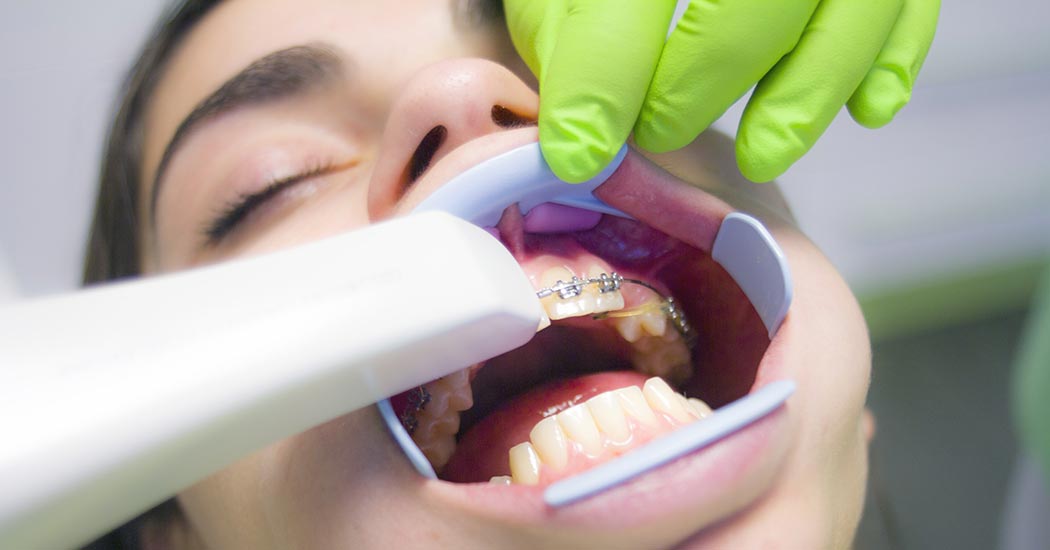 Ortodonti (Diş Teli Tedavisi)